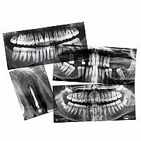 Dental X-Rays 